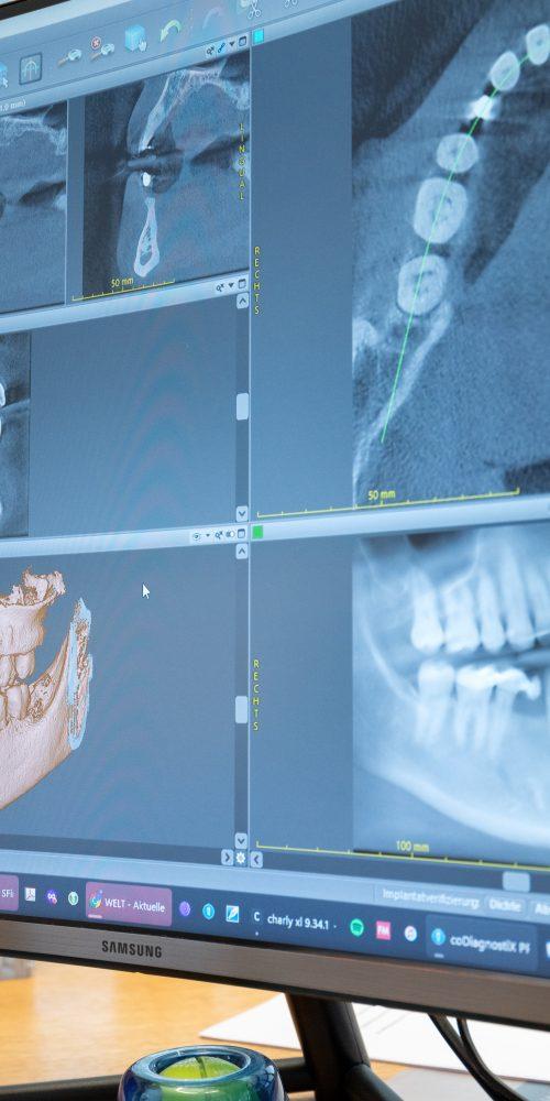 Periimplantitis, Röntgen