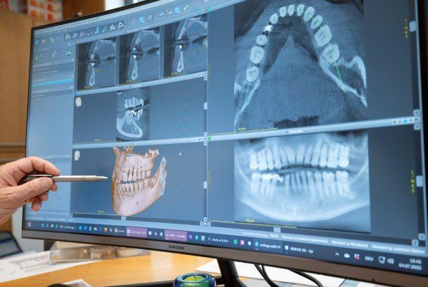 Periimplantitis, Röntgen