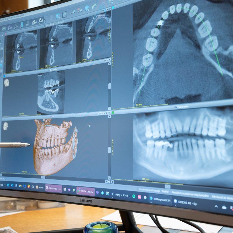 Periimplantitis, Röntgen